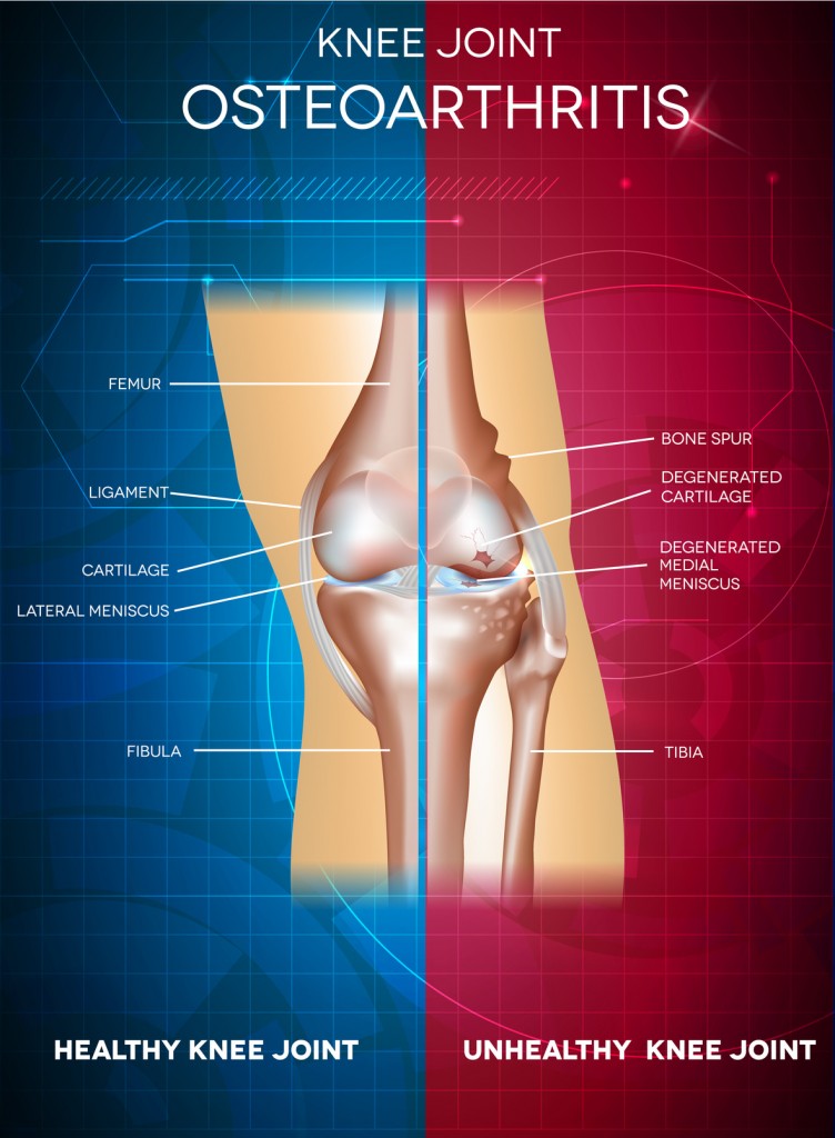 Knee Arthritis Solutions For Knee Ache Pain Relief Clinic Singapore