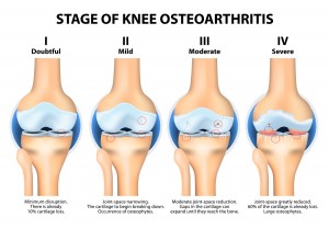 Stages of Knee Osteoarthritis (OA).